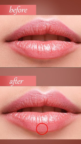 botox lips editor face shape 0