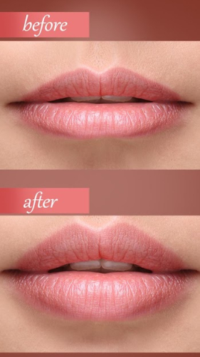 botox lips editor face shape 1